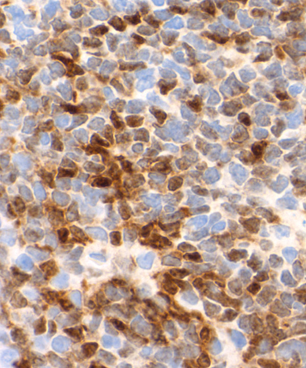 06 : HemMantle Cell Lymphoma