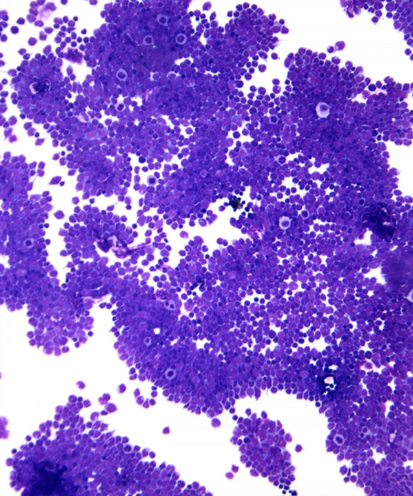 07 : HemMantle Cell Lymphoma