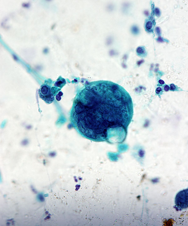 5 :  Infectious Diseases Coccidiodomycosis
