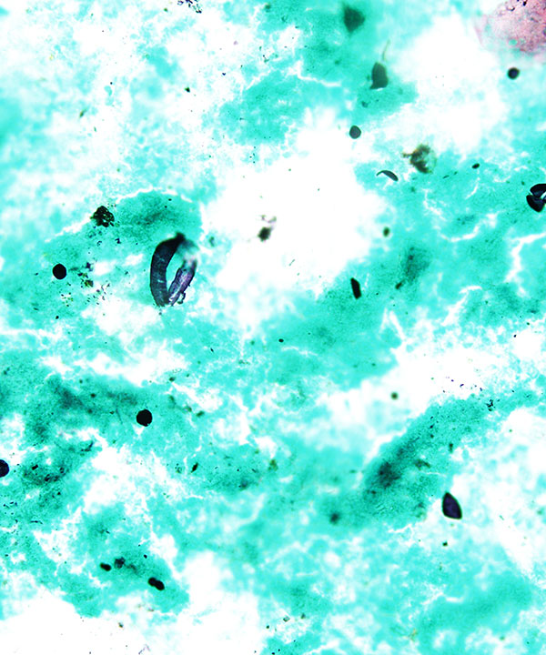 6 :  Infectious Diseases Coccidiodomycosis