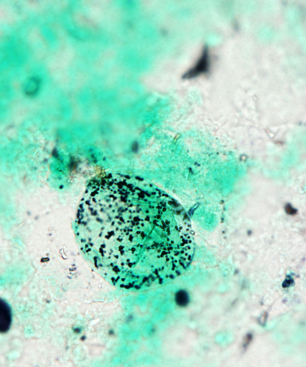 7 :  Infectious Diseases Coccidiodomycosis