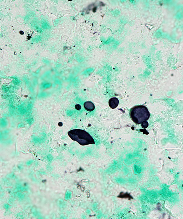 8 :  Infectious Diseases Coccidiodomycosis