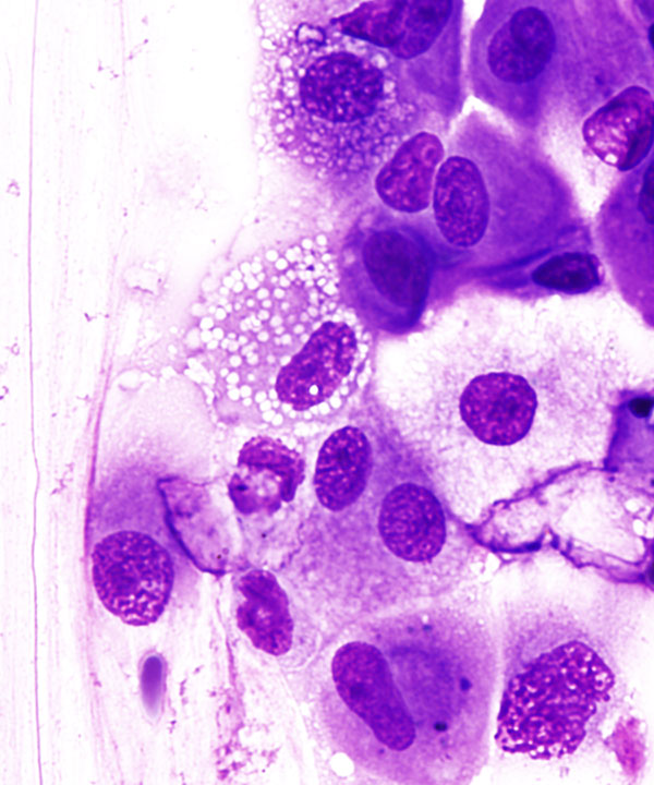 2 :  Infectious Diseases Histoplasmosis