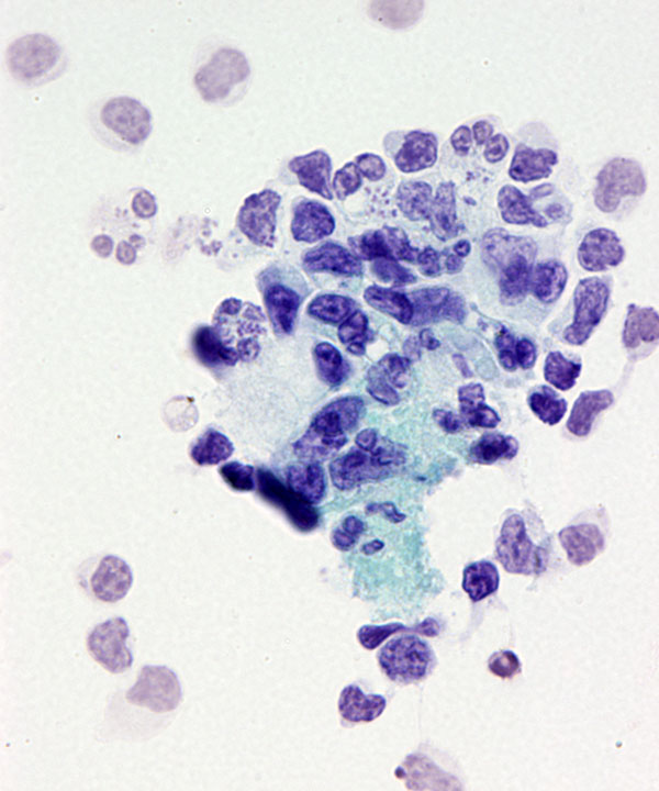 3 :  Infectious Diseases Histoplasmosis