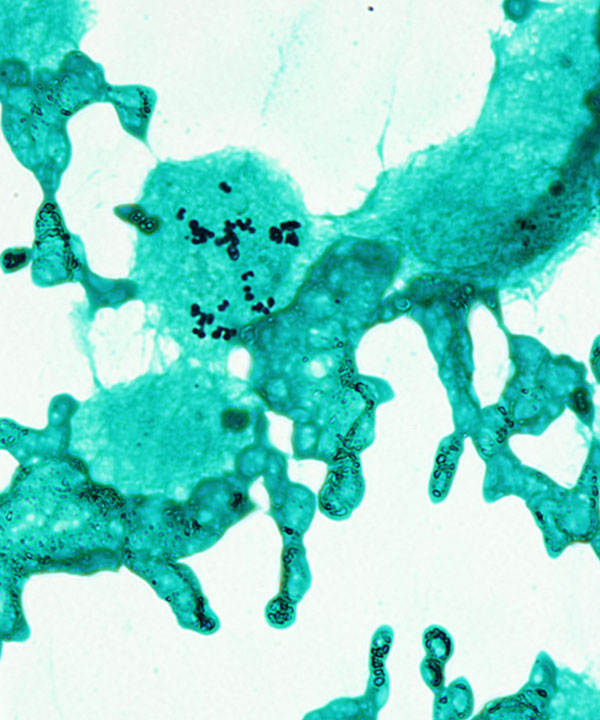 4 :  Infectious Diseases Histoplasmosis