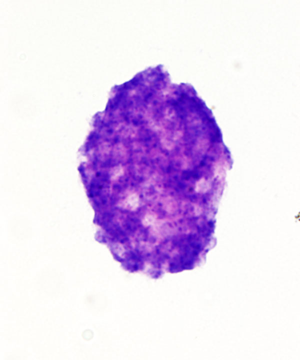2 :  Infectious Diseases Pneumocystis Pneumonia 