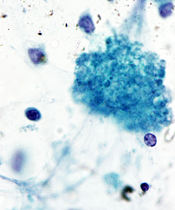 3 :  Infectious Diseases Pneumocystis Pneumonia 