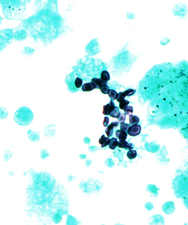 4 :  Infectious Diseases Pneumocystis Pneumonia 