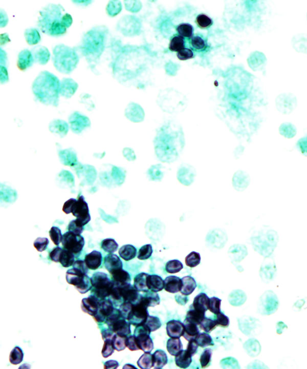 5 :  Infectious Diseases Pneumocystis Pneumonia 