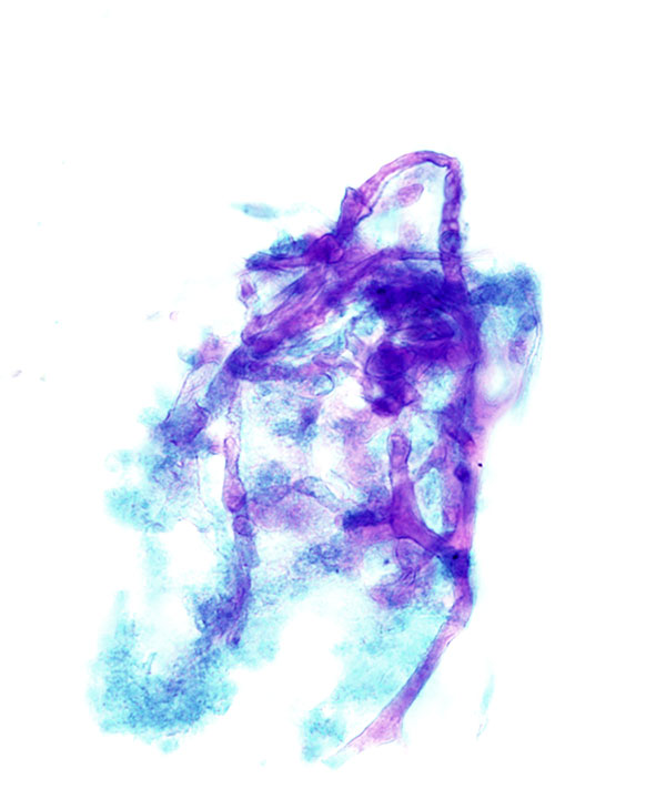 2 :  Infectious Diseases Zygomycosis