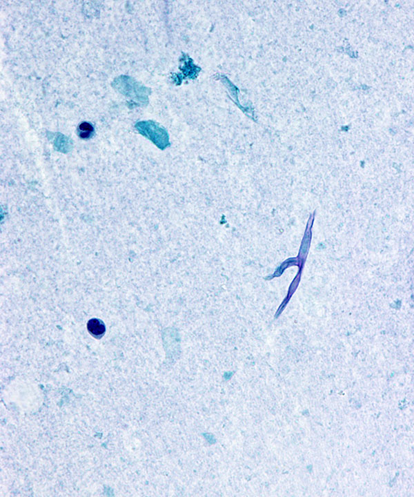 3 :  Infectious Diseases Zygomycosis
