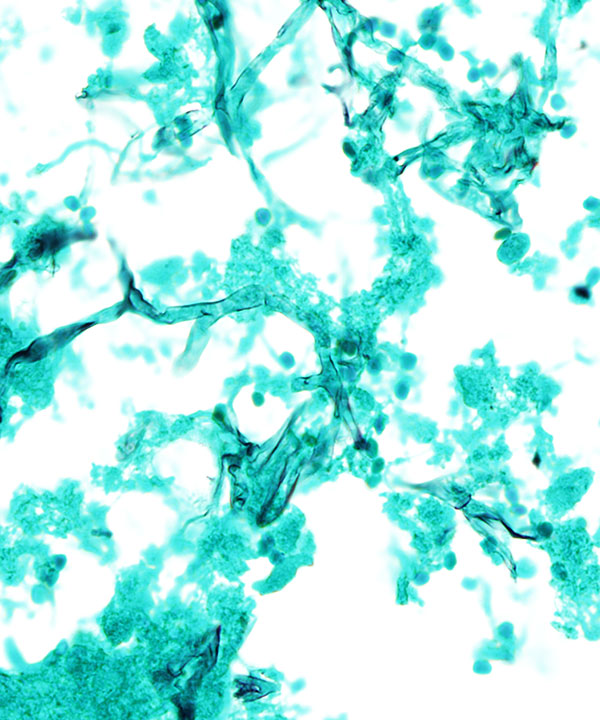 4 :  Infectious Diseases Zygomycosis