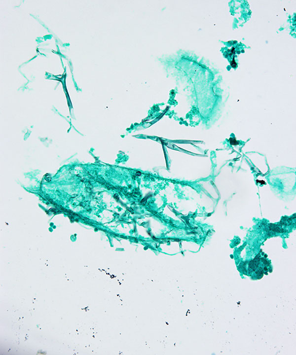 5 :  Infectious Diseases Zygomycosis
