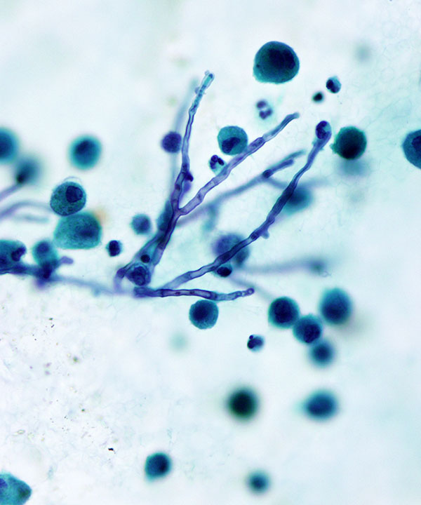 image showing 'Aspergillosis'
