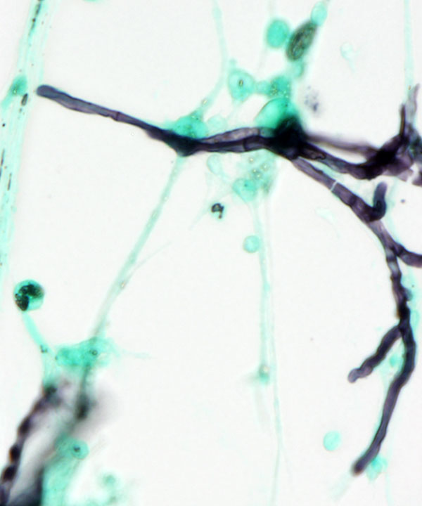 3 :  Infectious Diseases Aspergillosis