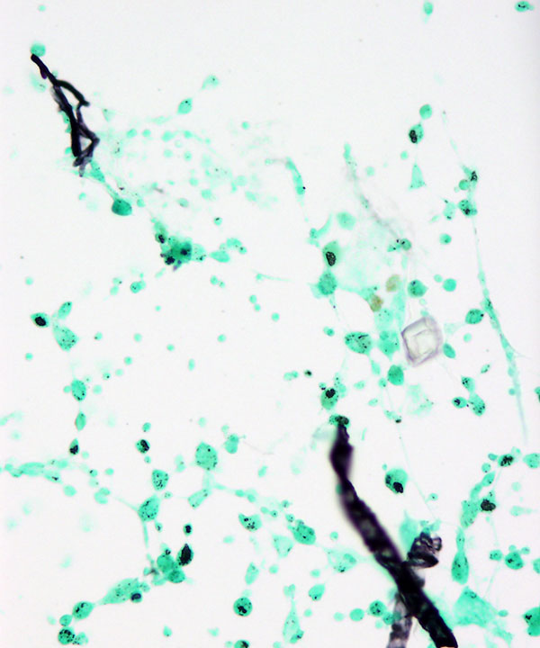 4 :  Infectious Diseases Aspergillosis