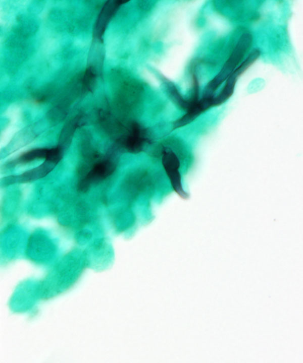 5 :  Infectious Diseases Aspergillosis