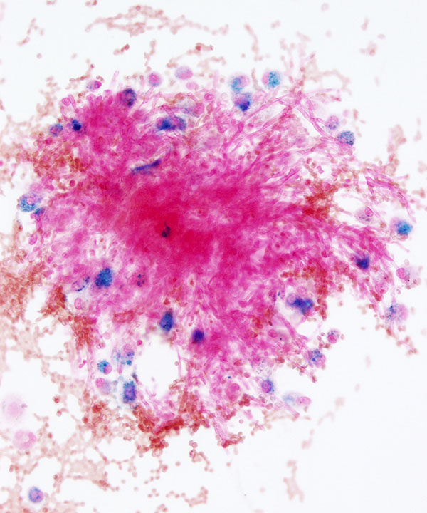 6 :  Infectious Diseases Aspergillosis