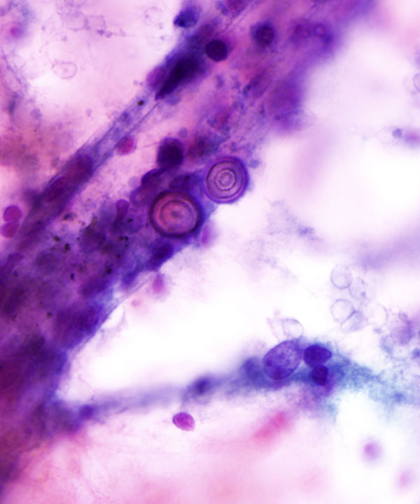 3 :  Infectious Diseases Blastomycosis