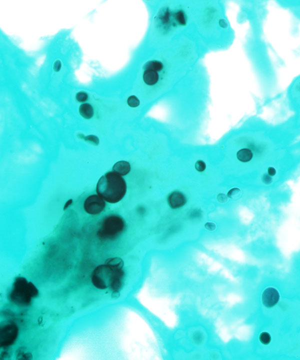 4 :  Infectious Diseases Blastomycosis