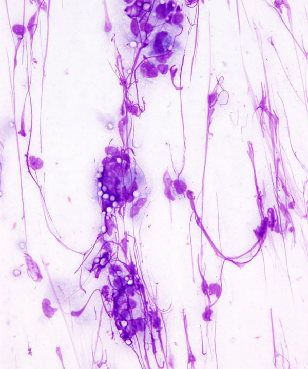 image showing 'Cryptococcosis'