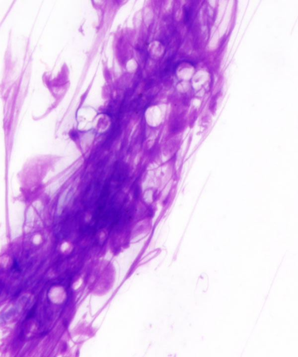 2 :  Infectious Diseases Cryptococcosis