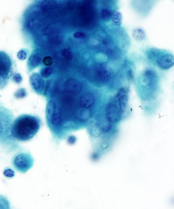 3 :  Infectious Diseases Cryptococcosis