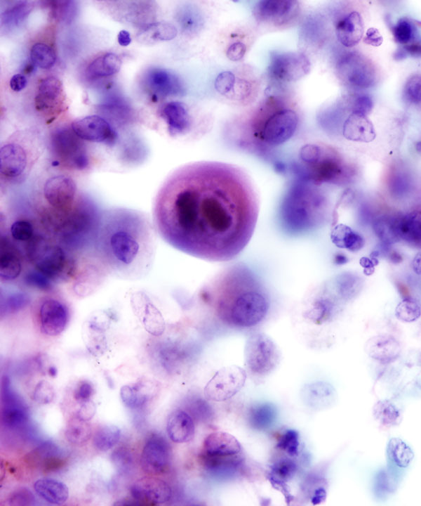 2 :  Infectious Diseases Cytomegalovirus Infection