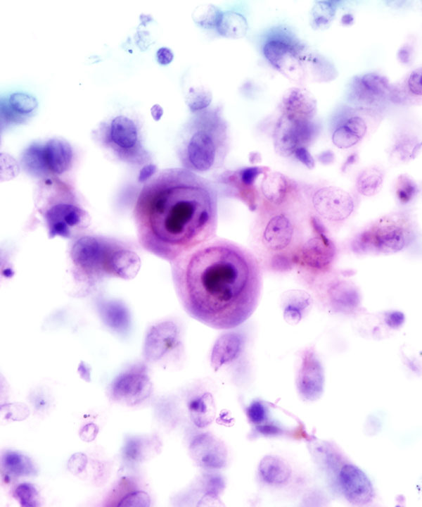 3 :  Infectious Diseases Cytomegalovirus Infection