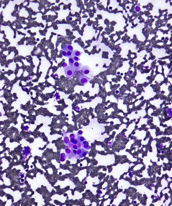 01 : Kidney Oncocytoma