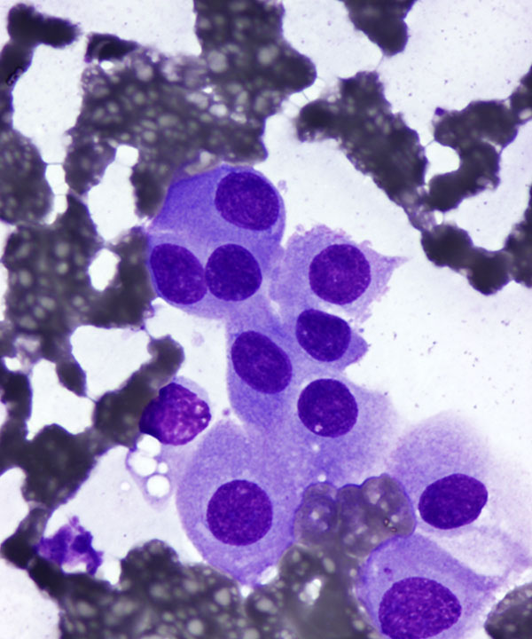 02 : Kidney Oncocytoma