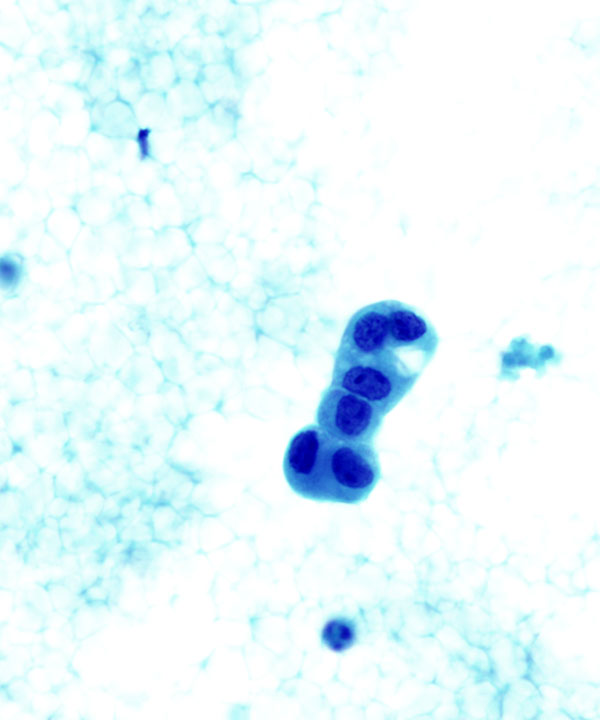 03 : Kidney Oncocytoma