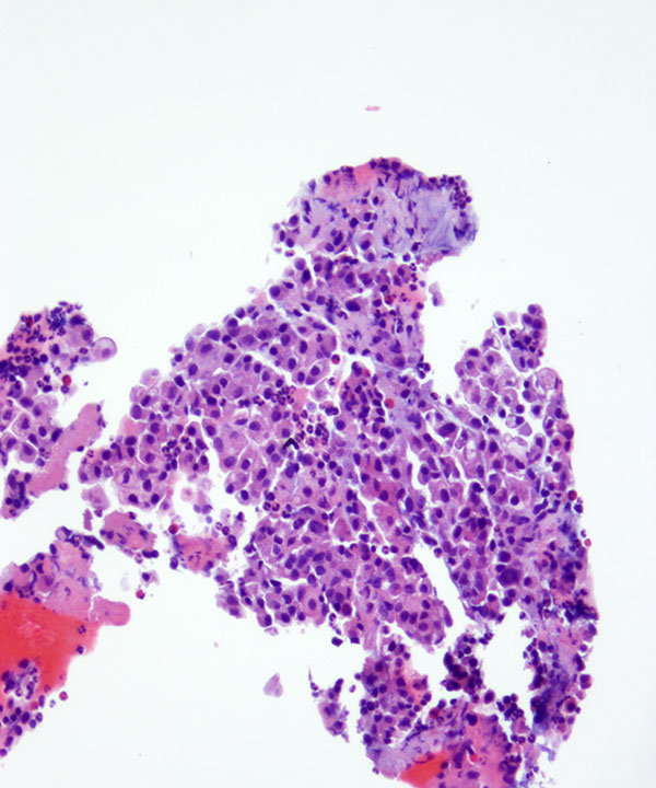 05 : Kidney Oncocytoma