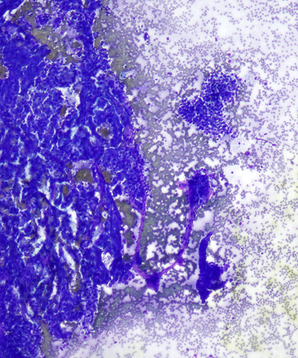 1 : Kidney Papillary Renal Cell Carcinoma - type I