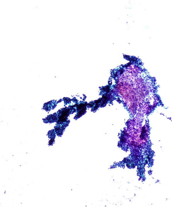 2 : Kidney Papillary Renal Cell Carcinoma - type I