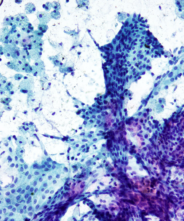 3 : Kidney Papillary Renal Cell Carcinoma - type I