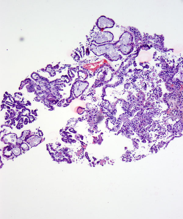 5 : Kidney Papillary Renal Cell Carcinoma - type I