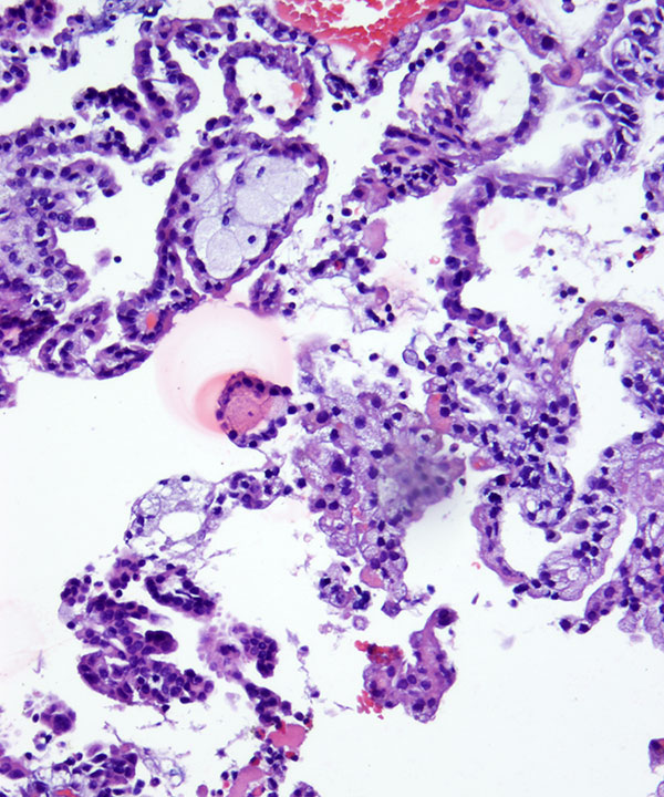6 : Kidney Papillary Renal Cell Carcinoma - type I