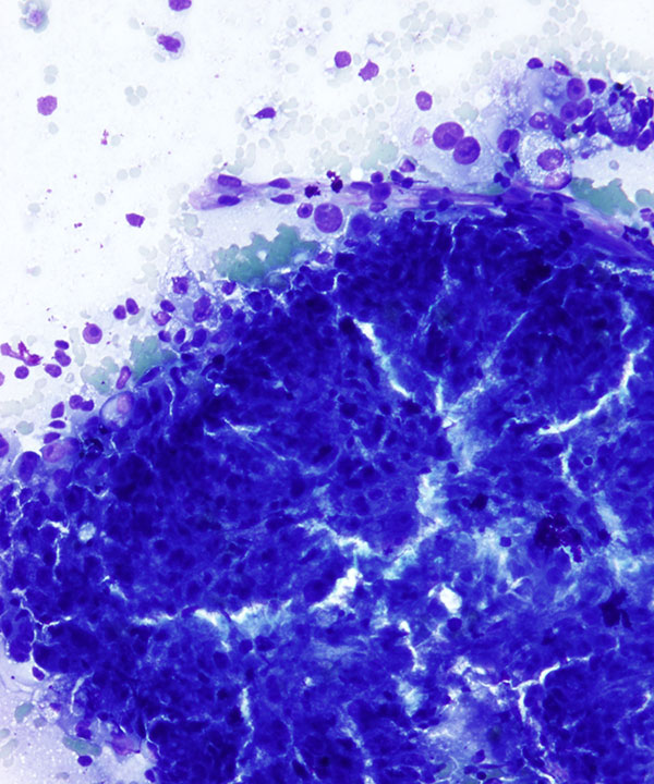 1 : Kidney Papillary Renal Cell Carcinoma - type II
