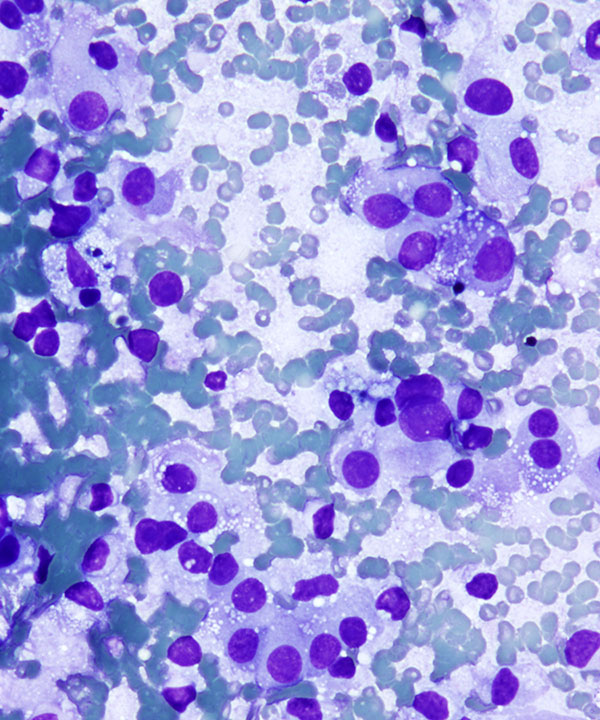 2 : Kidney Papillary Renal Cell Carcinoma - type II