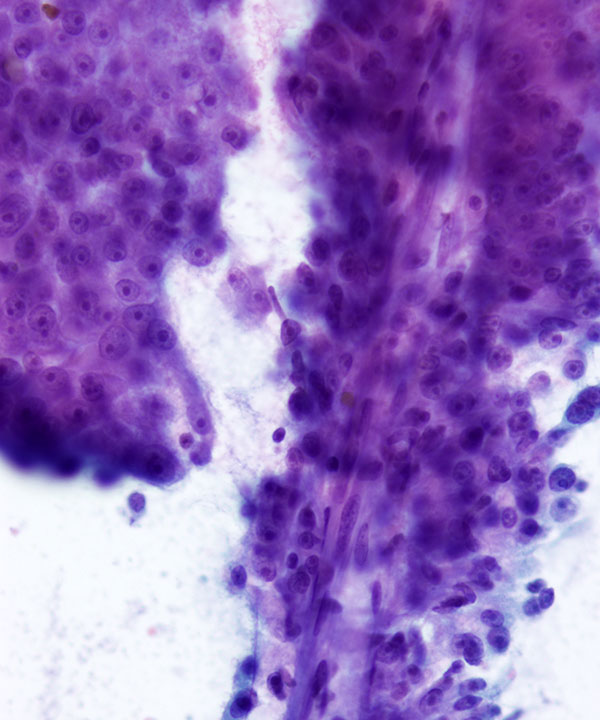 4 : Kidney Papillary Renal Cell Carcinoma - type II