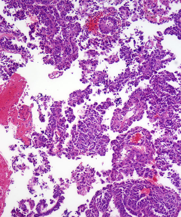 6 : Kidney Papillary Renal Cell Carcinoma - type II