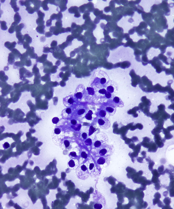 image showing 'Clear Cell Renal Cell Carcinoma'