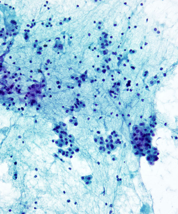 3 : Renal Cell Carcinoma Clear Cell