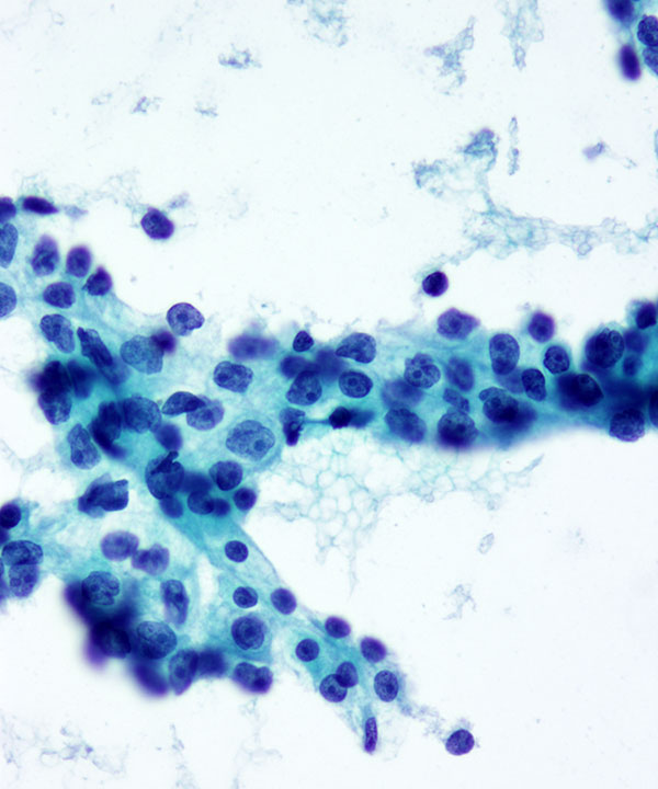 4 : Renal Cell Carcinoma Clear Cell