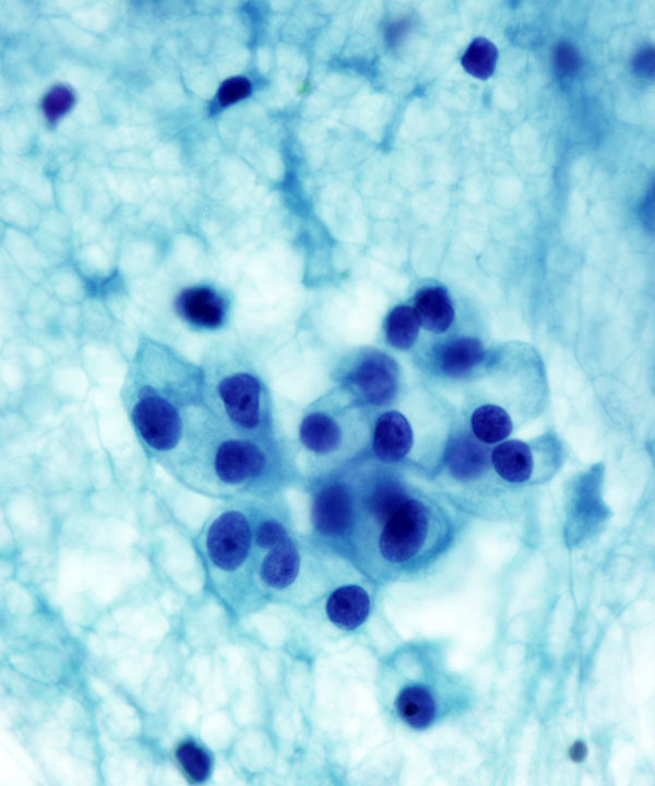 5 : Renal Cell Carcinoma Clear Cell