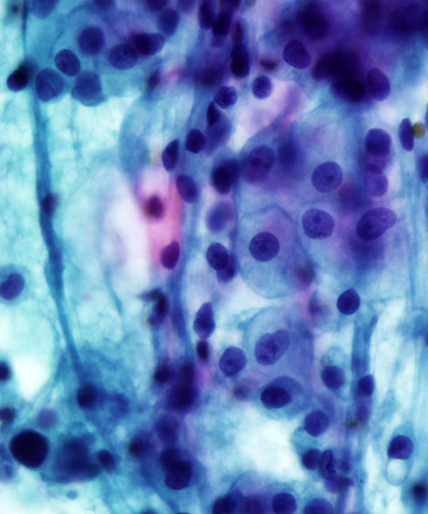 6 : Renal Cell Carcinoma Clear Cell