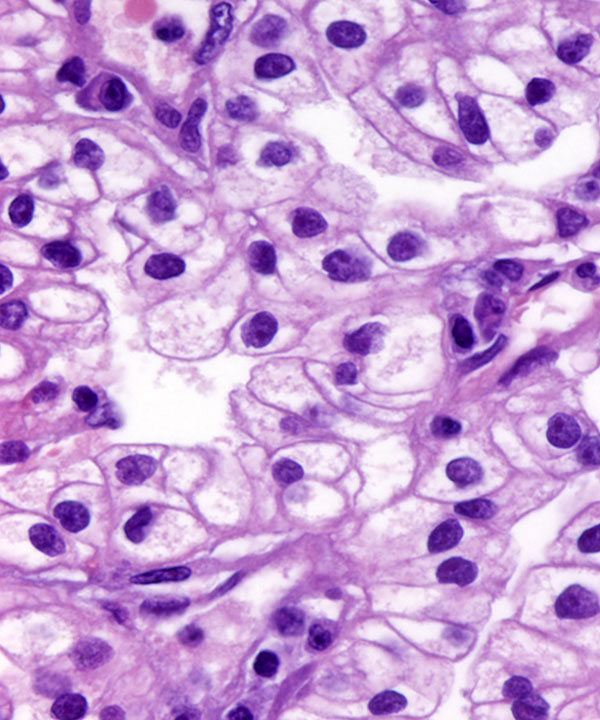 8 : Renal Cell Carcinoma Clear Cell