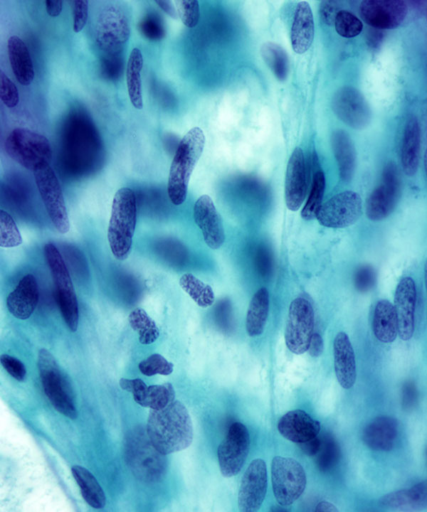 3 : Sarcomatoid Carcinoma