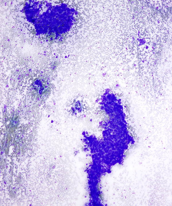 image showing 'Translocation Renal Cell Carcinoma'